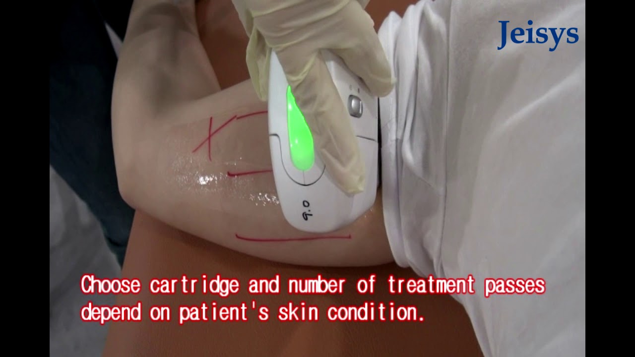 ULTRAcel Q+ Treatment Guide - Upper arm