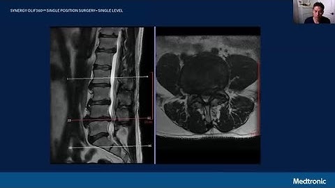 Surgical Case: Synergy OLIF360 Case Overview