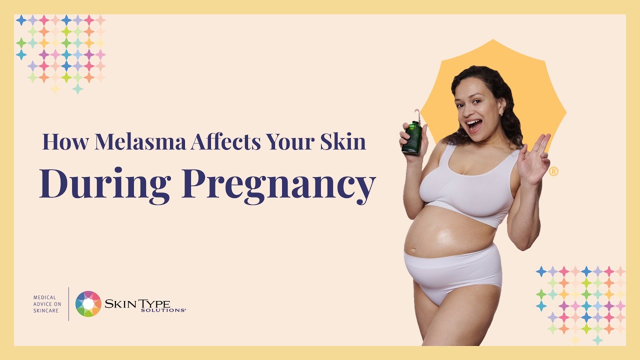 How to Prevent and Treat Melasma During Pregnancy YouTube