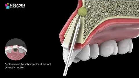 Megagen PET Kit - Pontic Shield Technique
