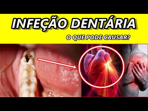 Vídeo: Infecção Do Canal Radicular: Causas, Sintomas, Prevenção, Tratamento