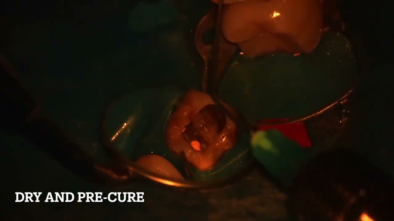 Fiber post cementation with Gradia Core GC