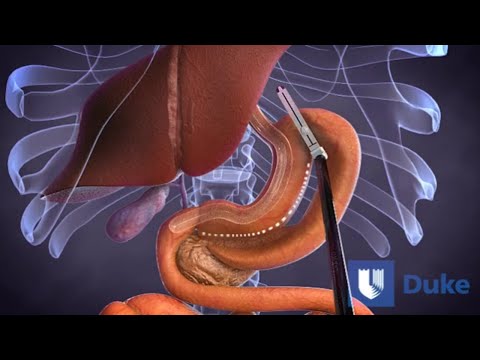 Video: Kan de twaalfvingerige darm worden verwijderd?