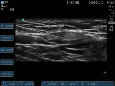 lateral cutaneous femoral nerve block by mario tedesco - youtube lateral cutaneous femoral nerve block by mario tedesco - youtube, Muscles