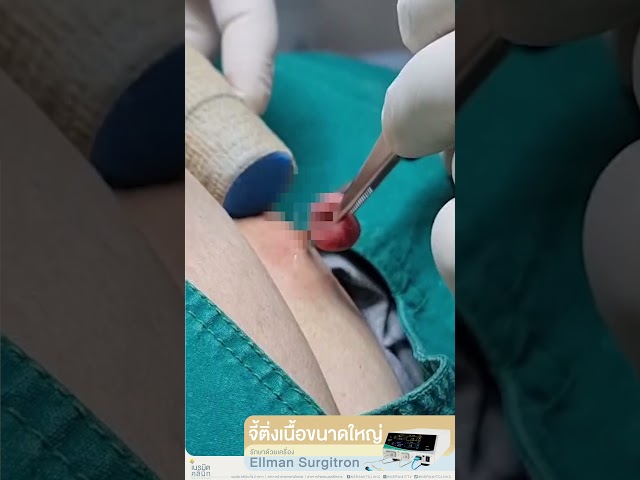 จี้ติ่งเนื้อขนาดใหญ่ที่เอว