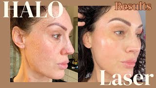 Get Glowing Skin Fast: My Unbelievable Results with Halo Laser! by The Glam Belle 13,549 views 1 year ago 13 minutes, 13 seconds