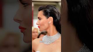 Perfect Side Profile Like Adriana Lima? Facial Aesthetics At Zoh Aesthetic Clinic Hyderabad