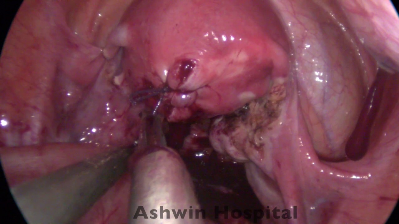 video editing software free SILS Salpingectomy for Ectopic pregnancy + Myomectomy with intracoporeal suturing