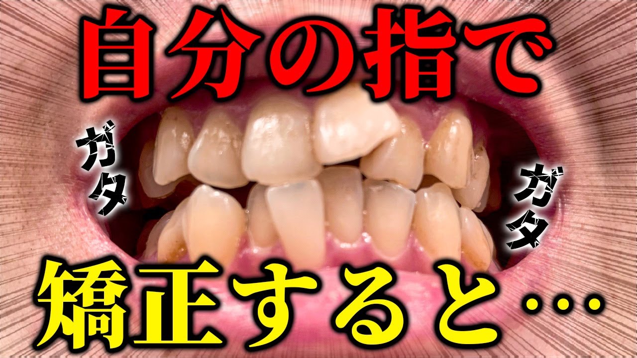 出っ歯 治す 自力