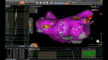 Electroanatomical mapping of the left atrium