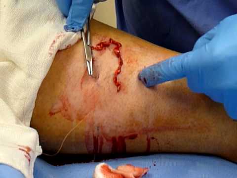 do compression socks work for varicose veins