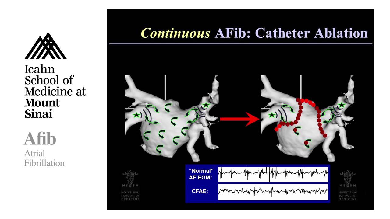 Jimmys Story: My Experience With Atrial Fibrillation Jimmys Story: My Experience With Atrial Fibrillation new pictures Jimmys Story: My Experience With Atrial Fibrillation Jimmys Story: My Experience With Atrial Fibrillation new photo