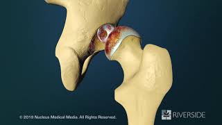 Total Hip Replacement