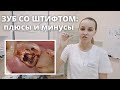 Зуб со штифтом: плюсы и минусы