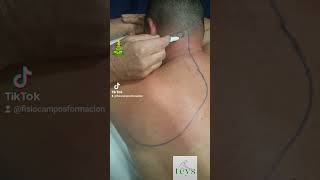 Teys & Cervicalgia Izquierda