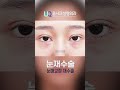 비대칭쌍꺼풀 눈매교정 재수술전후#shorts