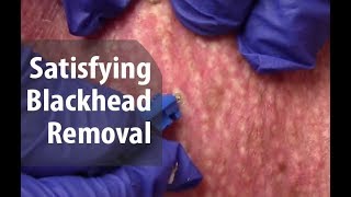 Satisfying Removal Of Blackheads | Dr. Derm