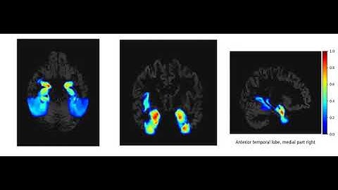 Modeling Spatial Progression of Dementia caused by Alzheimer