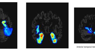 Modeling Spatial Progression of Dementia caused by Alzheimer's disease with Deep Learning