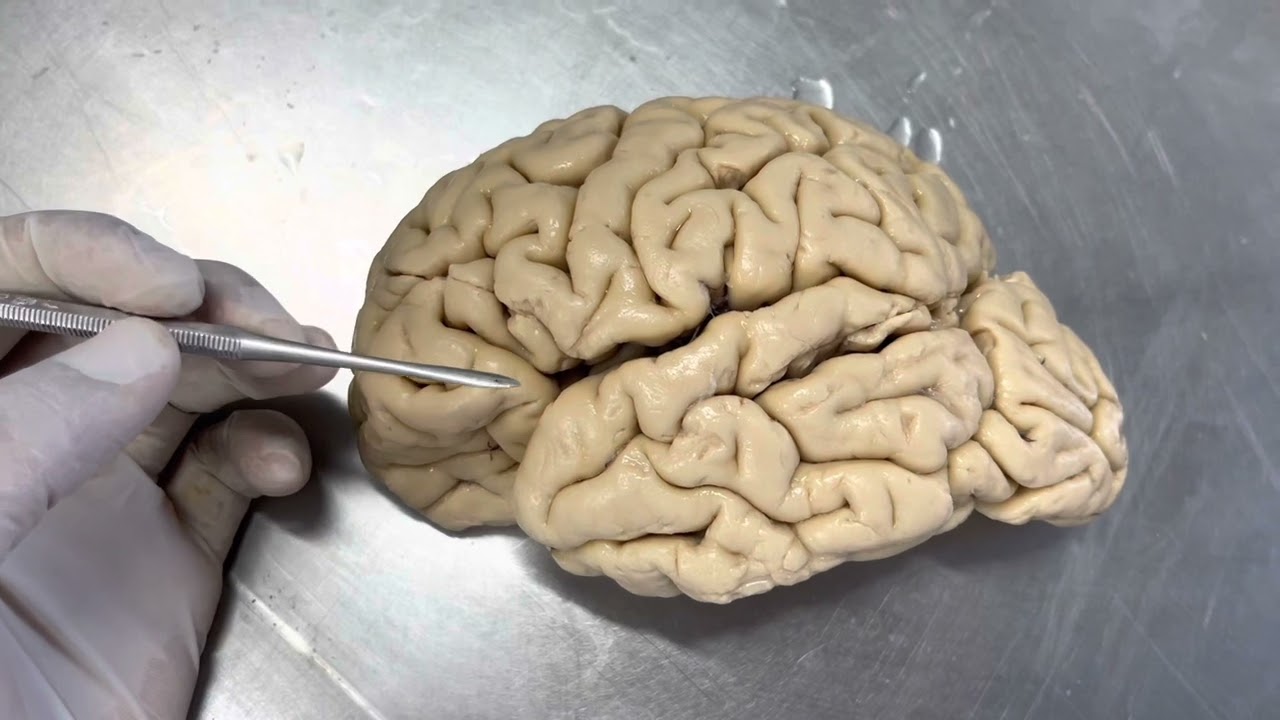 Explicação anatômica da gagueira (disfemia)