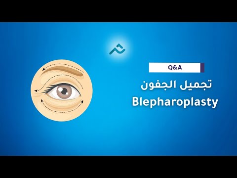   تجميل الجفون 