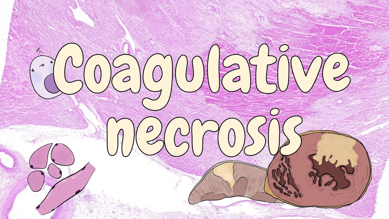 Coagulative necrosis general pathology YouTube