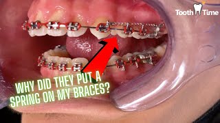 Why did they put a spring on my braces? Dental Coil Springs - Tooth Time Family  New Braunfels