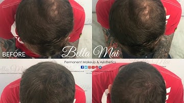1. Scalp Micropigmentation - Before & After Density