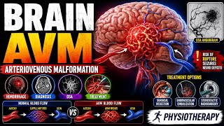 ARTERIOVENOUS MALFORMATION (AVM) | PATHOPHYSIOLOGY | CLINICAL FEATURES | DIAGNOSIS & MANAGEMENT