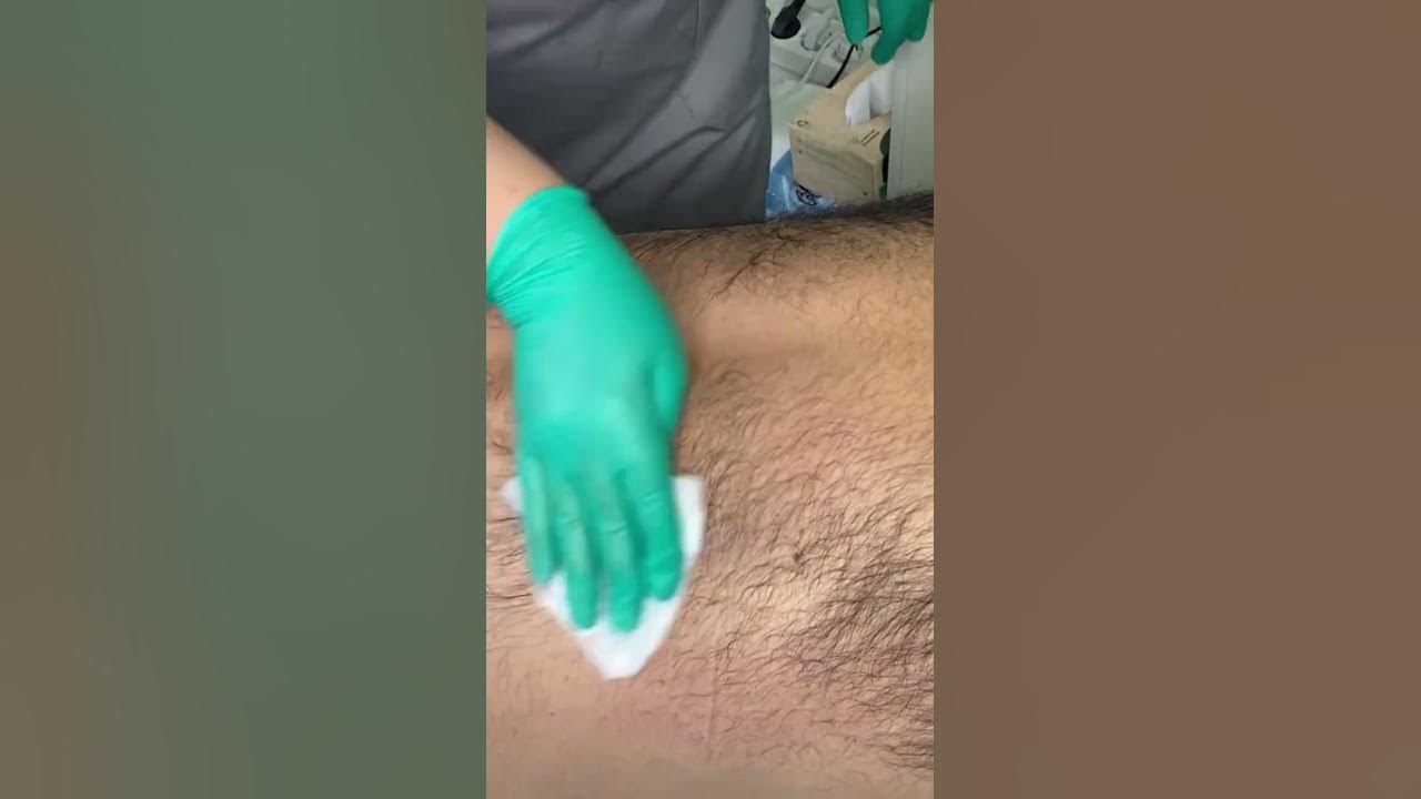 Мужская депиляция спины
