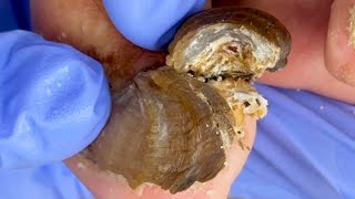 Trim Twisted Toenails And Solve Foot Problems! 【Doctor Liu Pedicure】