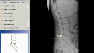 TraumaCad - Spondylolysthesis