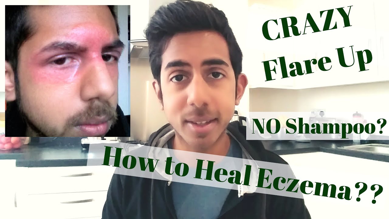 NEVER use Shampoo? | Major Eczema Flare Up | Q&A Wednesday 