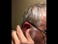 Bee sting in the ear #bee #workerbee #beelife #beekeeping #honey #beewhisperer #beebite