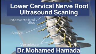 Lower Cervical Nerve Roots Ultrasound Scaning/Dr.Mohamed Hamada