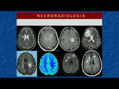 Video: Encefalomielite Acuta Disseminata: Sintomi, Trattamento, Conseguenze