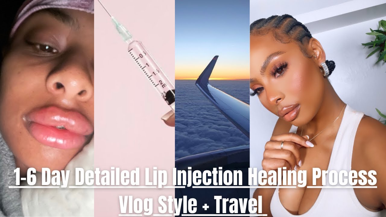 6 day Detailed Lip Injection Healing Process | Vlog Style | Travel