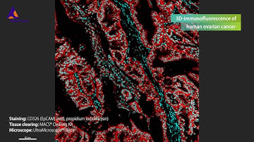3D-immunofluorescence of a human ovarian cancer stained with CD326 (EpCAM) Antibody