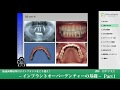 《総義歯難症例》インプラントオーバーデンチャーの基礎 #1【金澤学先生】- Basics in Implant Overdentures