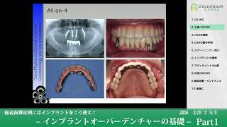 《総義歯難症例》インプラントオーバーデンチャーの基礎 #1【金澤学先生】- Basics in Implant Overdentures
