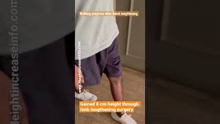 Gained 8Cm Height Through Limb Lengthening Surgery With