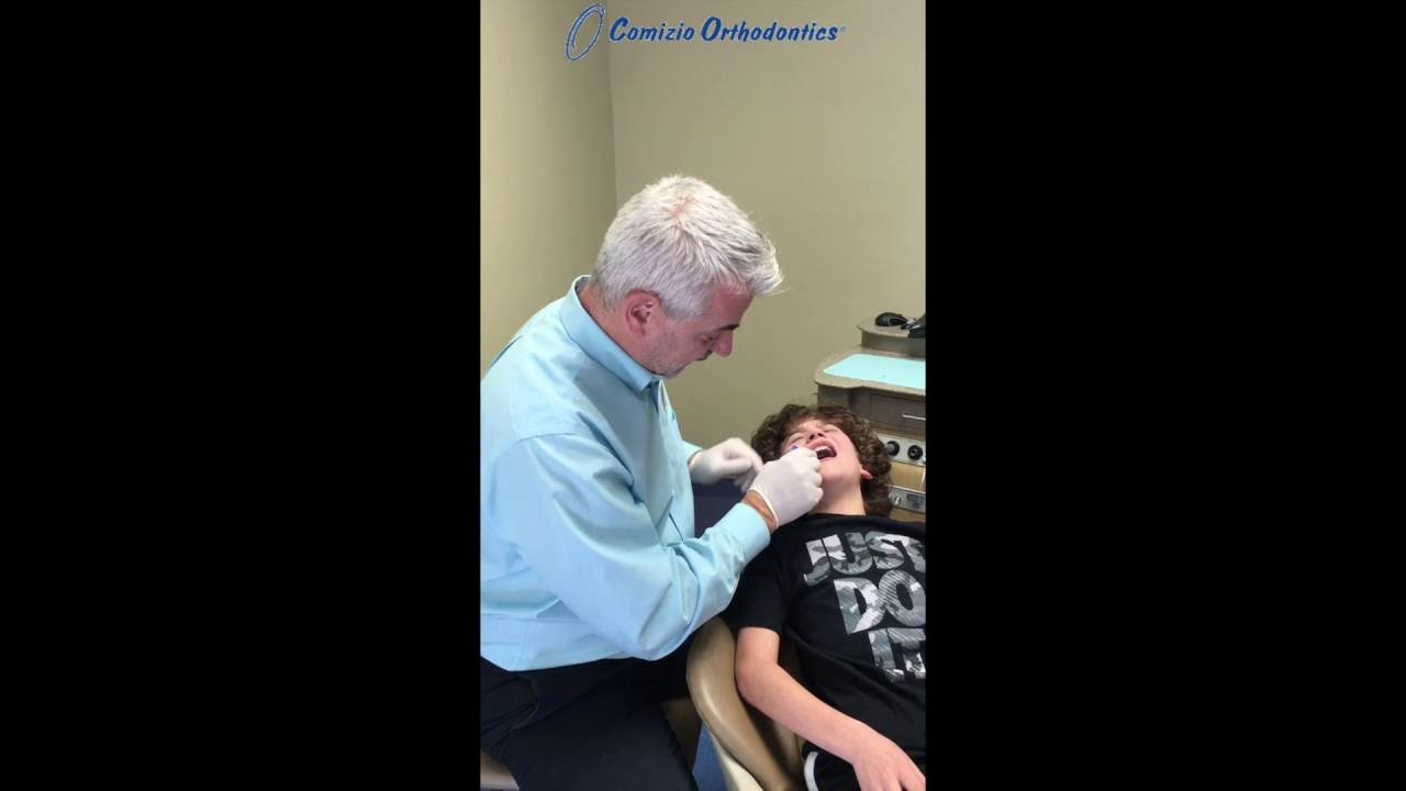 Rapid Palatal Expander Activation Demonstration