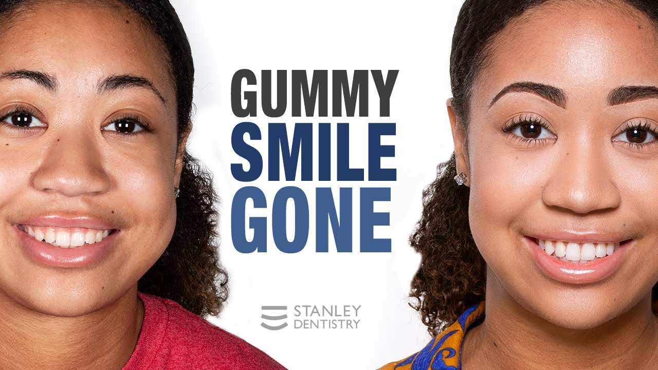Go smile. Gummy smile. smile to go. gummy smile men.