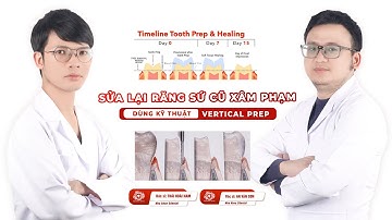 Sửa Lại Răng Sứ Cũ Xâm Phạm Dùng Kỹ Thuật Vertical Prep | Bác sỹ An Văn Sơn Sdental