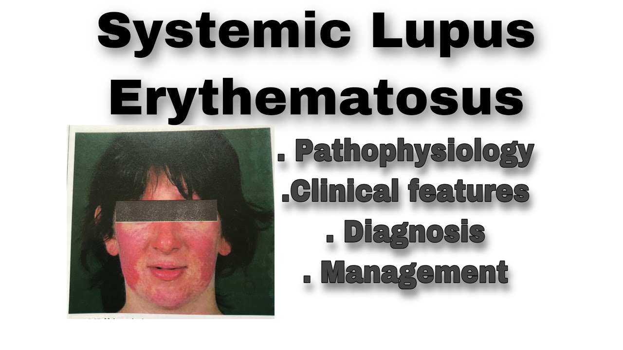 Systemic Lupus ErythematosusPathophysiologyDiagnosisManagementRheumatology YouTube
