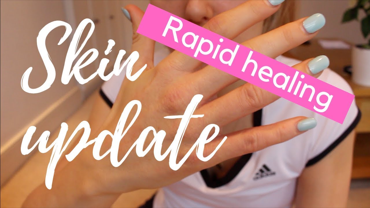 Eczema skin healing process (UPDATE  3 MONTHS) | Natural eczema healing journey