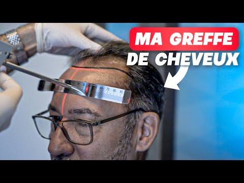 Je Filme Ma Chirurgie Esthetique De Greffe De Cheveux A Istanbul En Turquie C'est Vraiment Fou !!!