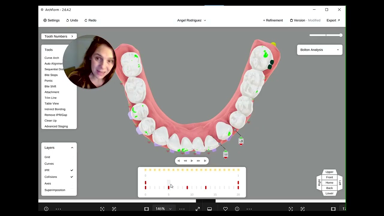 Errores e importancia del staging durante el tratamiento. CASO REAL: