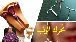 اعراض وأسباب تحرك اللولب من مكانه وهل  يحدث حمل مع وجود  اللولب ؟