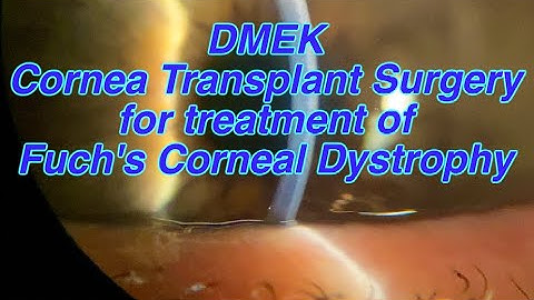 DMEK Cornea Transplant Surgery for treatment of Fuch